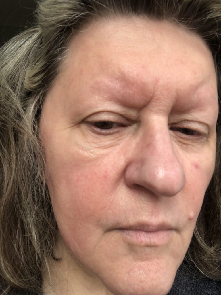 end april 22 rosacea face josordoni
